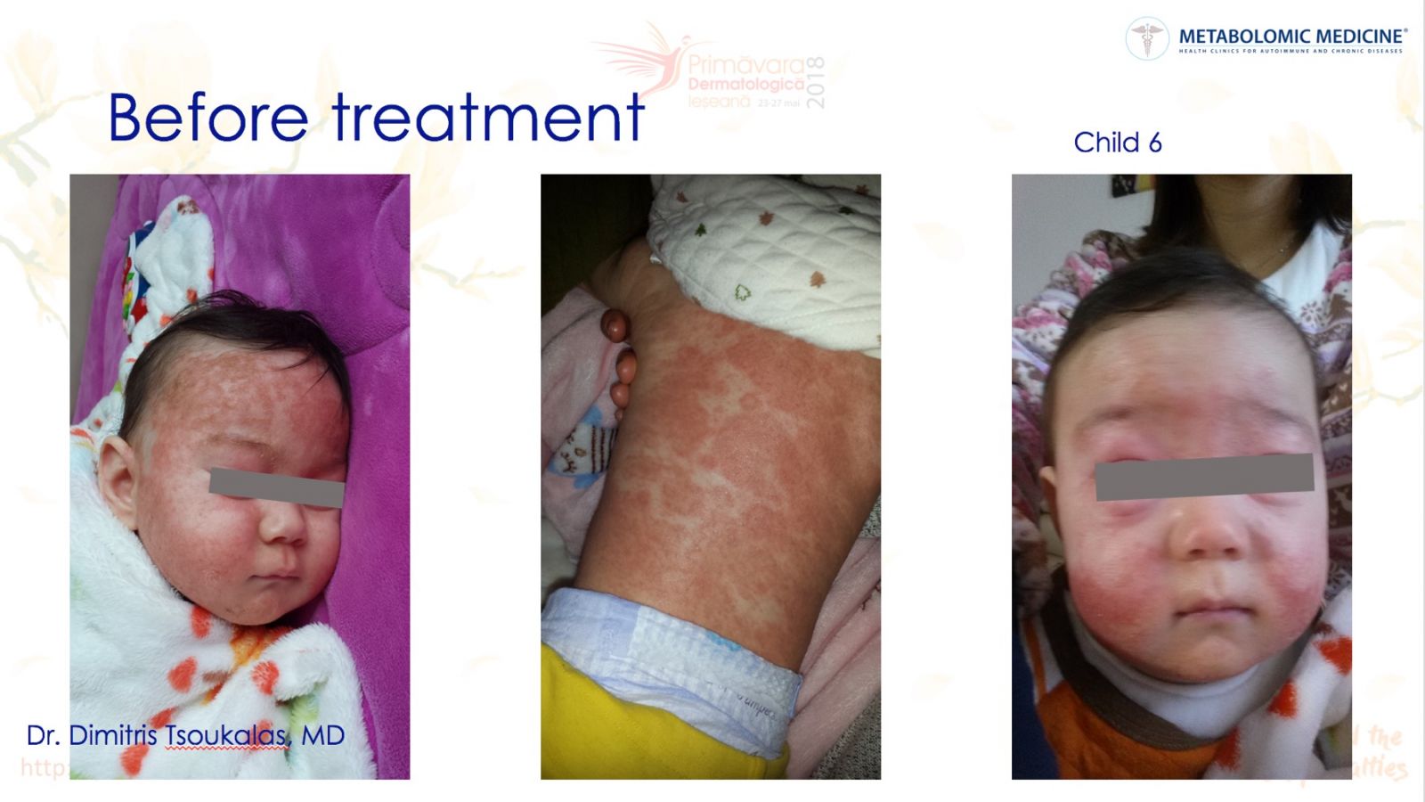 Children With Atopic Dermatitis
